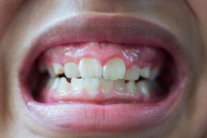 erosión dental
