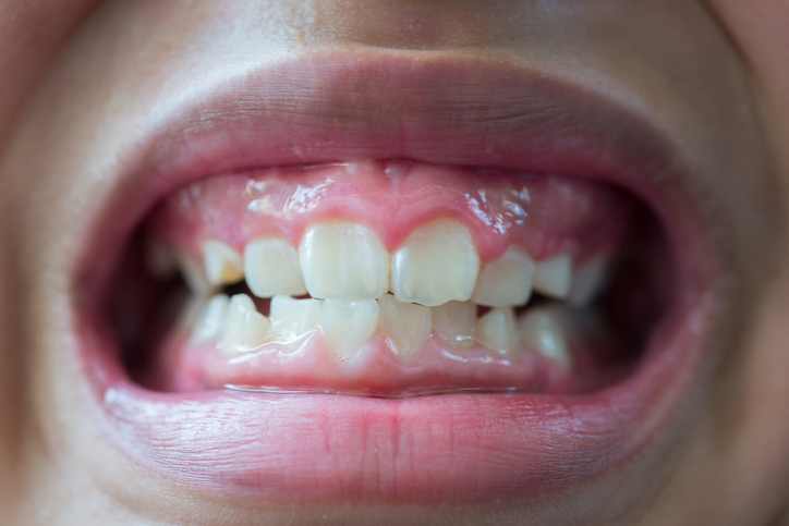 erosión dental