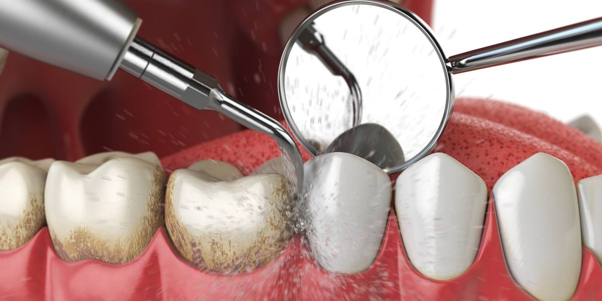 Periodoncia en Ugena y El Señorío de Illescas. tratamiento para las encías en Ugena y El Señorío de Illescas.
