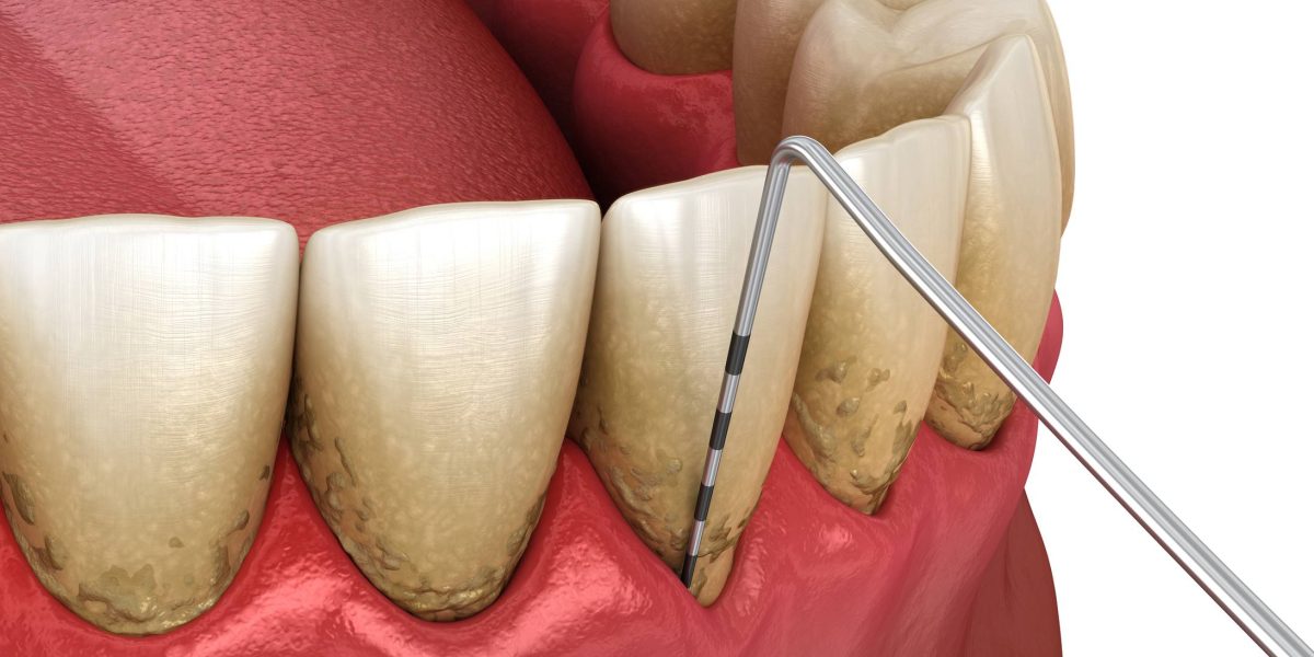Periodoncia en Ugena y El Señorío de Illescas. tratamiento para las encías en Ugena y El Señorío de Illescas.