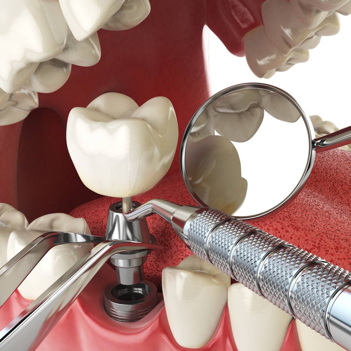 Cuida los tejidos profundos de tu boca con cirugía oral en Ugena y El Señorío de Illescas. Servicio quirúrgico seguro, personalizado y libre de dolor.