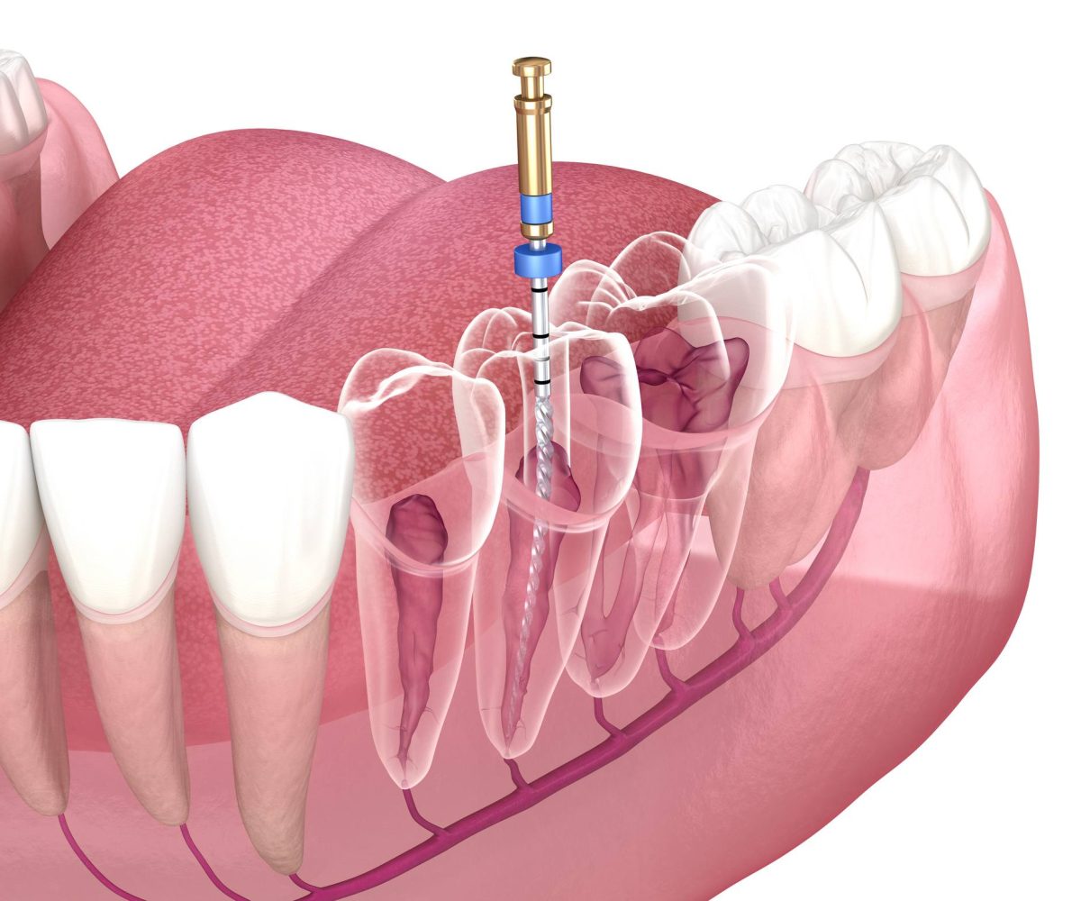 endodoncia conductos