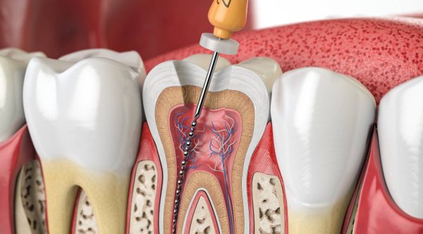 endodoncia_ttto