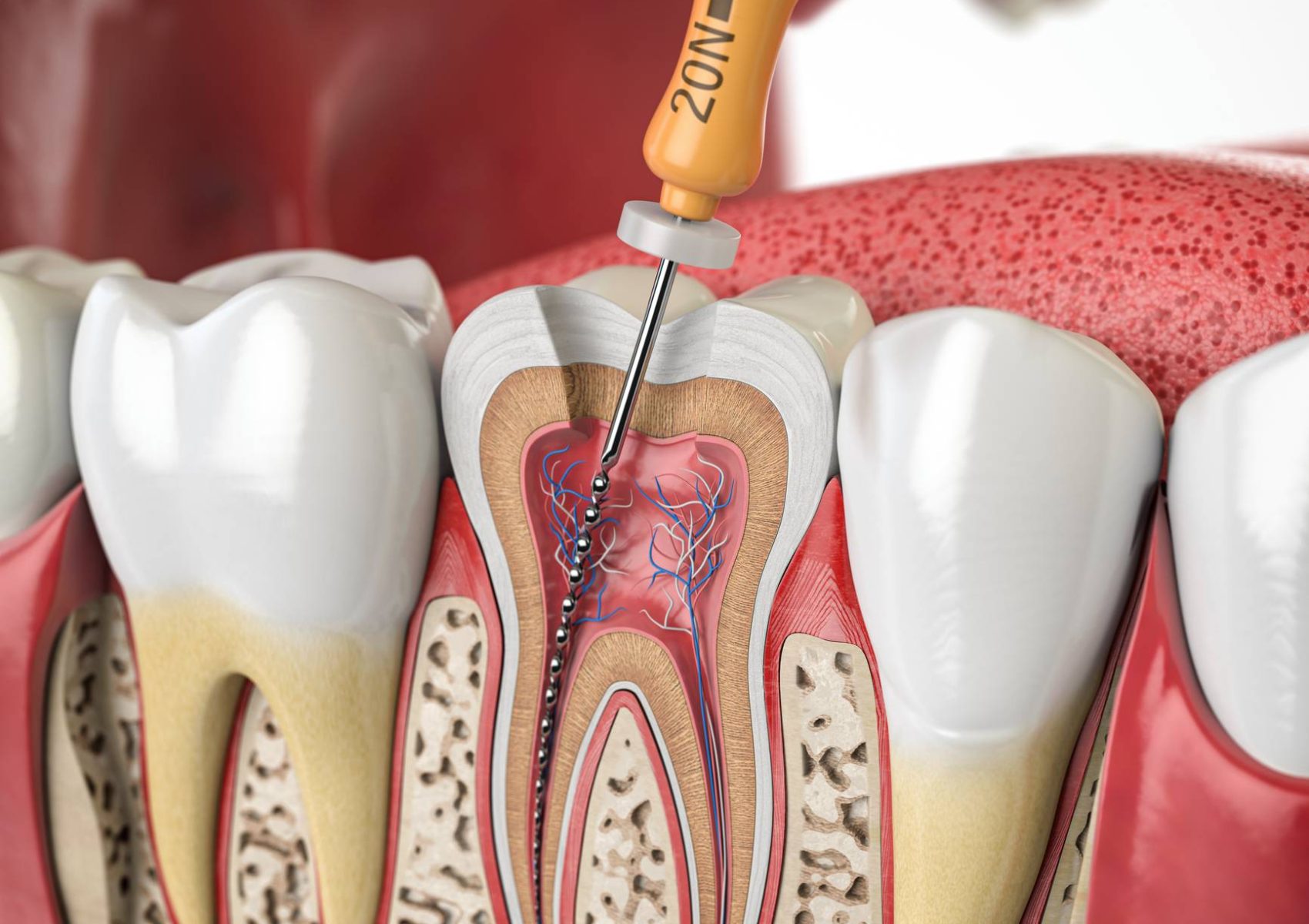 endodoncia_ttto