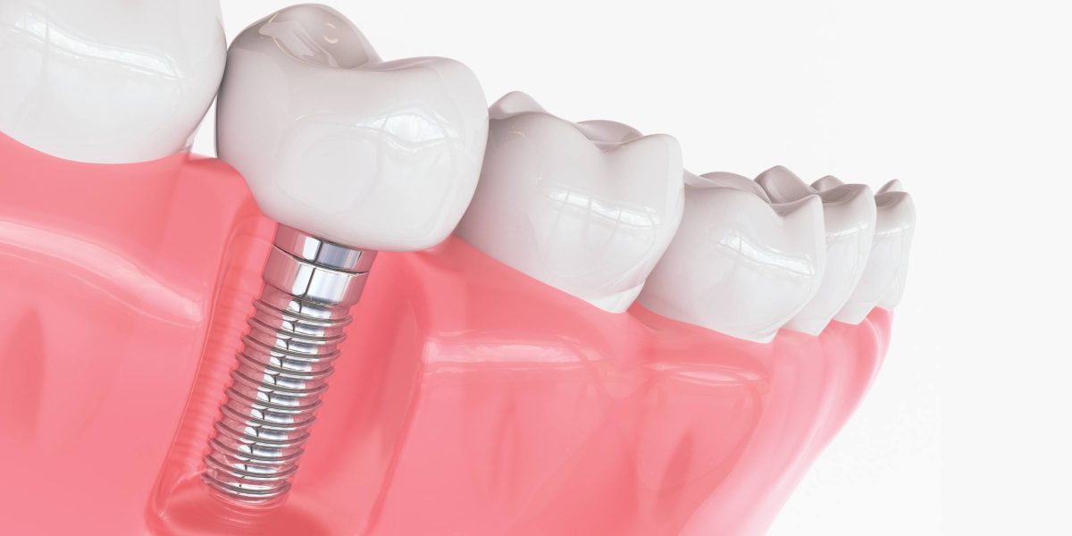 implantes dentales en Ugena y El Señorío de Illescas. Implantología Oral en Ugena y El Señorío de Illescas, implantes en Ugena y El señorío de Illescas.