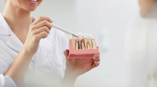 implantes dentales en Ugena y El Señorío de Illescas. Implantología Oral en Ugena y El Señorío de Illescas, implantes en Ugena y El señorío de Illescas.