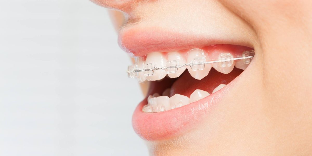 Ortodoncia en Ugena y El Señorío de Illescas. Ortodoncia de brackets metálicos en Ugena y El Señorío, ortodoncia de brackets estéticos en Ugena y El Señorío, ortodoncia invisible en El Señorío, ortodoncia infantil en Ugena y El Señorío, ortopedia en Ugena y El Señorío.