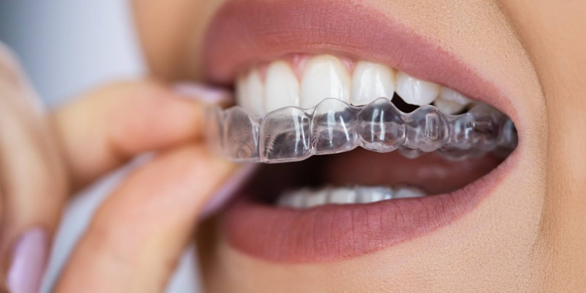 Ortodoncia en Ugena y El Señorío de Illescas. Ortodoncia de brackets metálicos en Ugena y El Señorío, ortodoncia de brackets estéticos en Ugena y El Señorío, ortodoncia invisible en El Señorío, ortodoncia infantil en Ugena y El Señorío, ortopedia en Ugena y El Señorío.