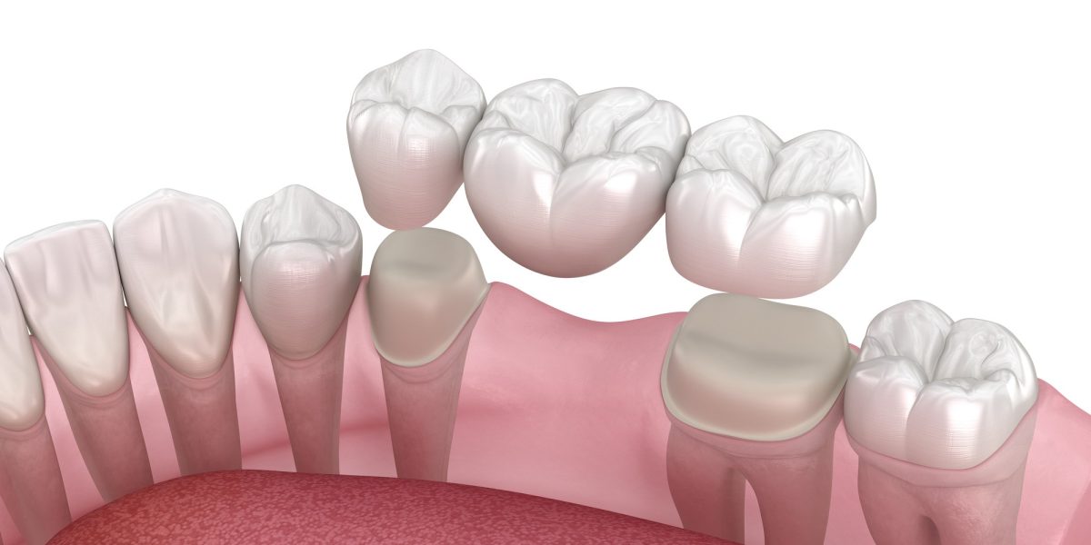 protesis dental fija pueste