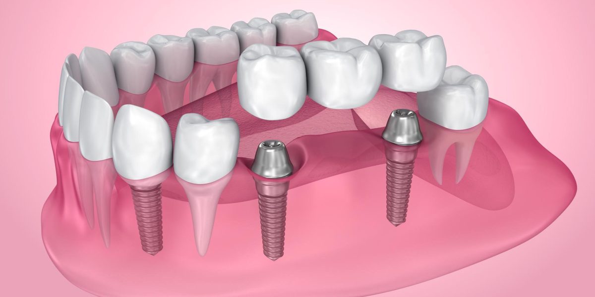 puente sobre implantes