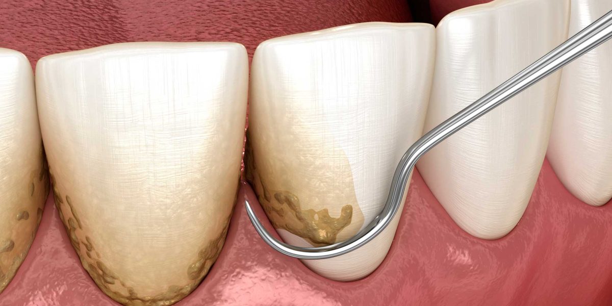 Periodoncia en Ugena y El Señorío de Illescas. tratamiento para las encías en Ugena y El Señorío de Illescas.